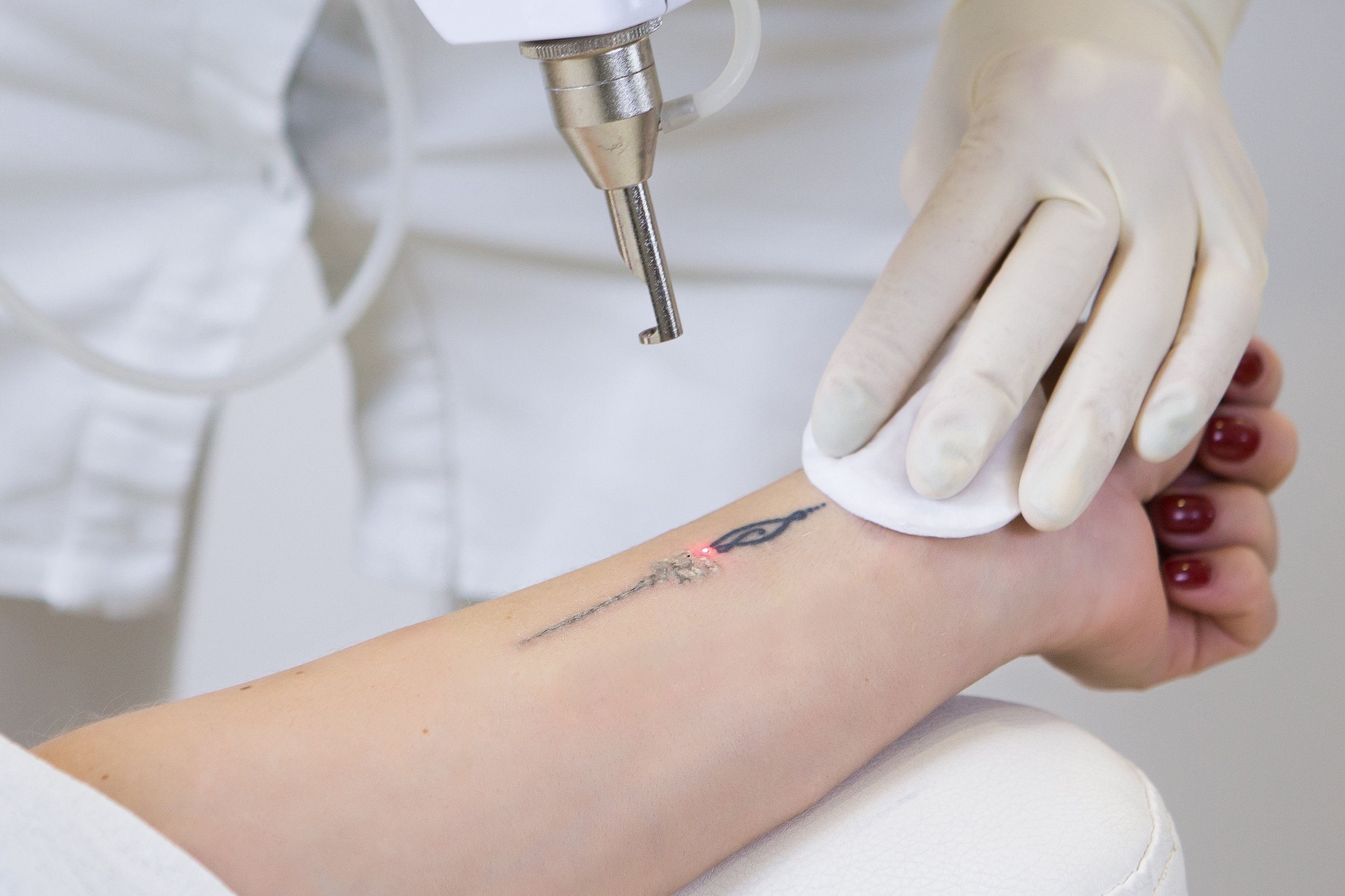 Tattoo removal treatment